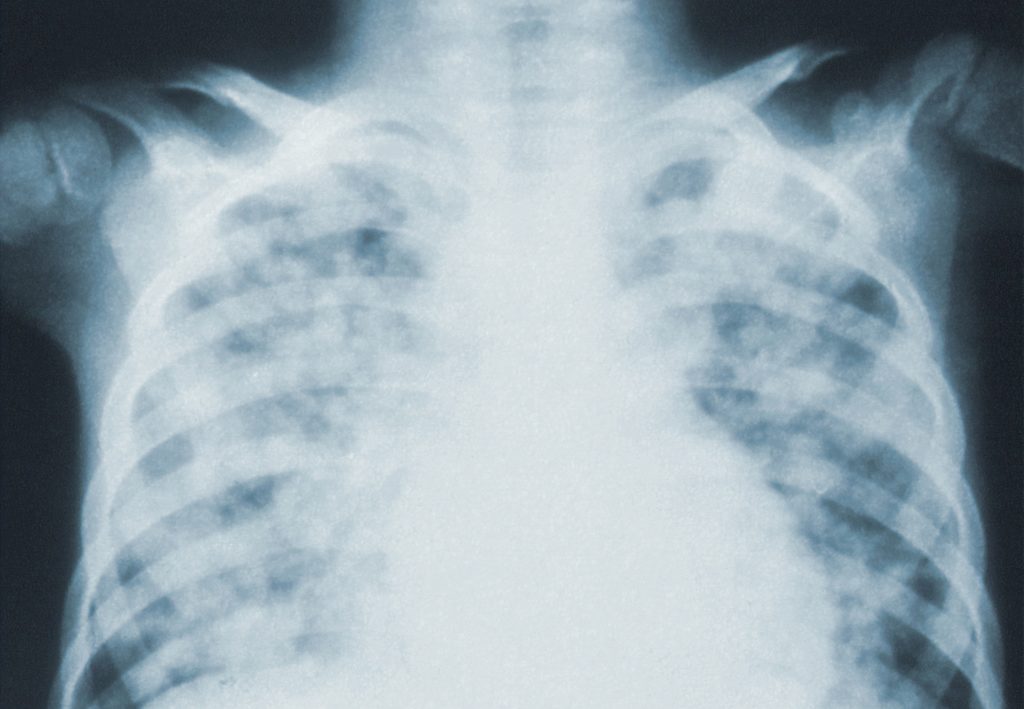 Lung damage found in COVID-19 patients months after infection